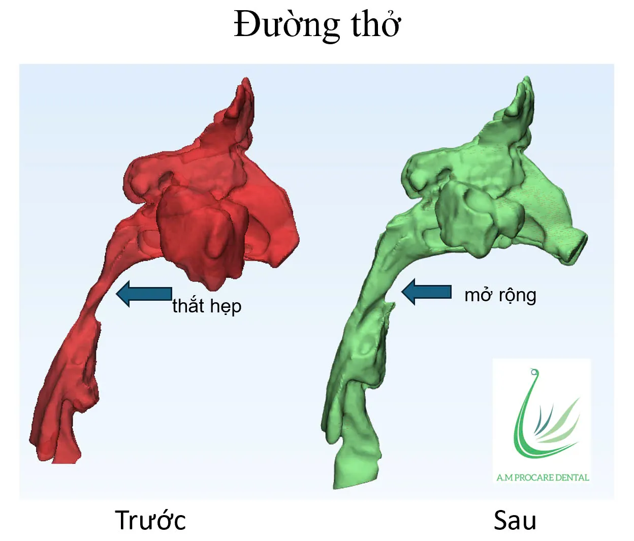 Ngủ ngáy, ngủ há miệng có thể là biểu hiện bệnh lý ngừng thở khi ngủ