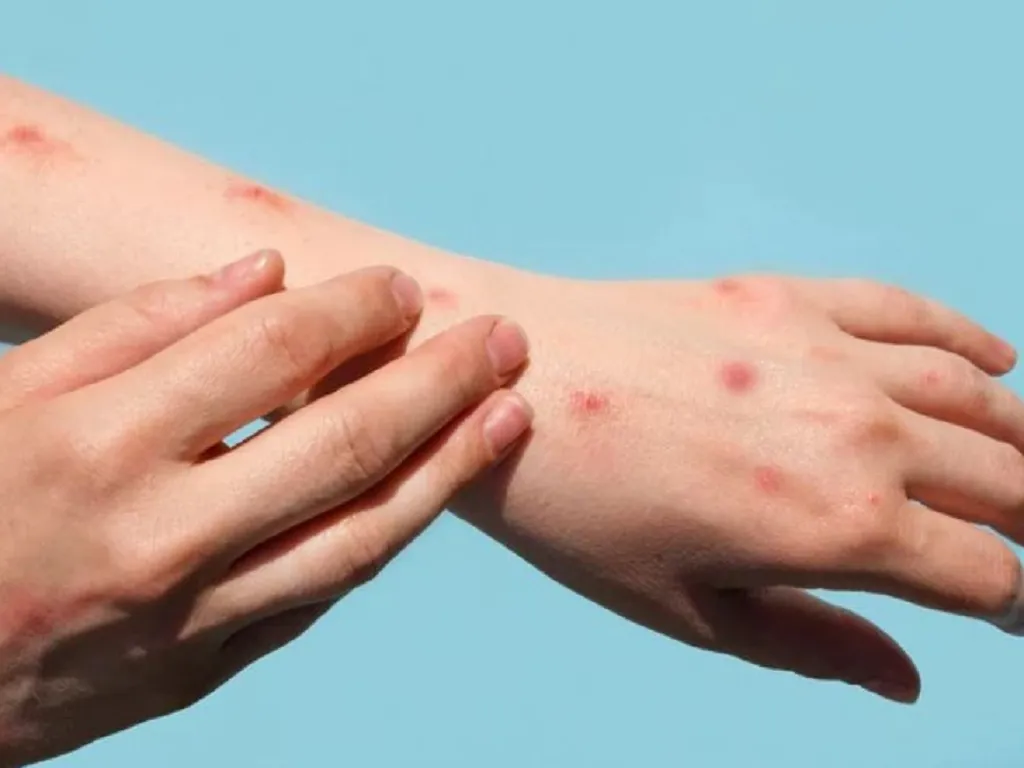 Lào Cai tăng cường phòng, chống bệnh đậu mùa khỉ