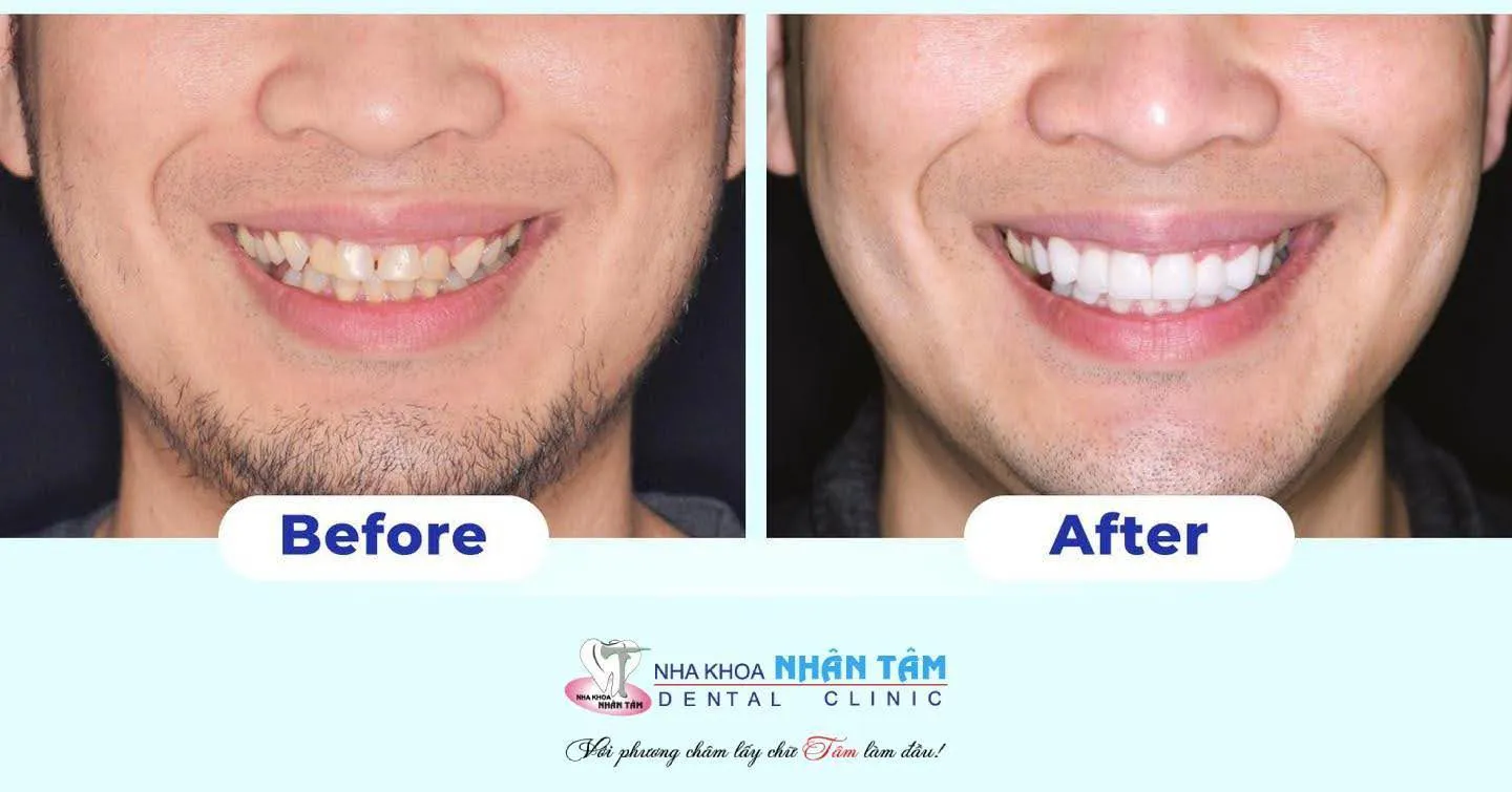 Nụ cười mơ ước với phương pháp trồng răng sứ tại Nha khoa Nhân Tâm